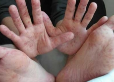 Вірус Коксаки або синдром "рука-нога-рот"